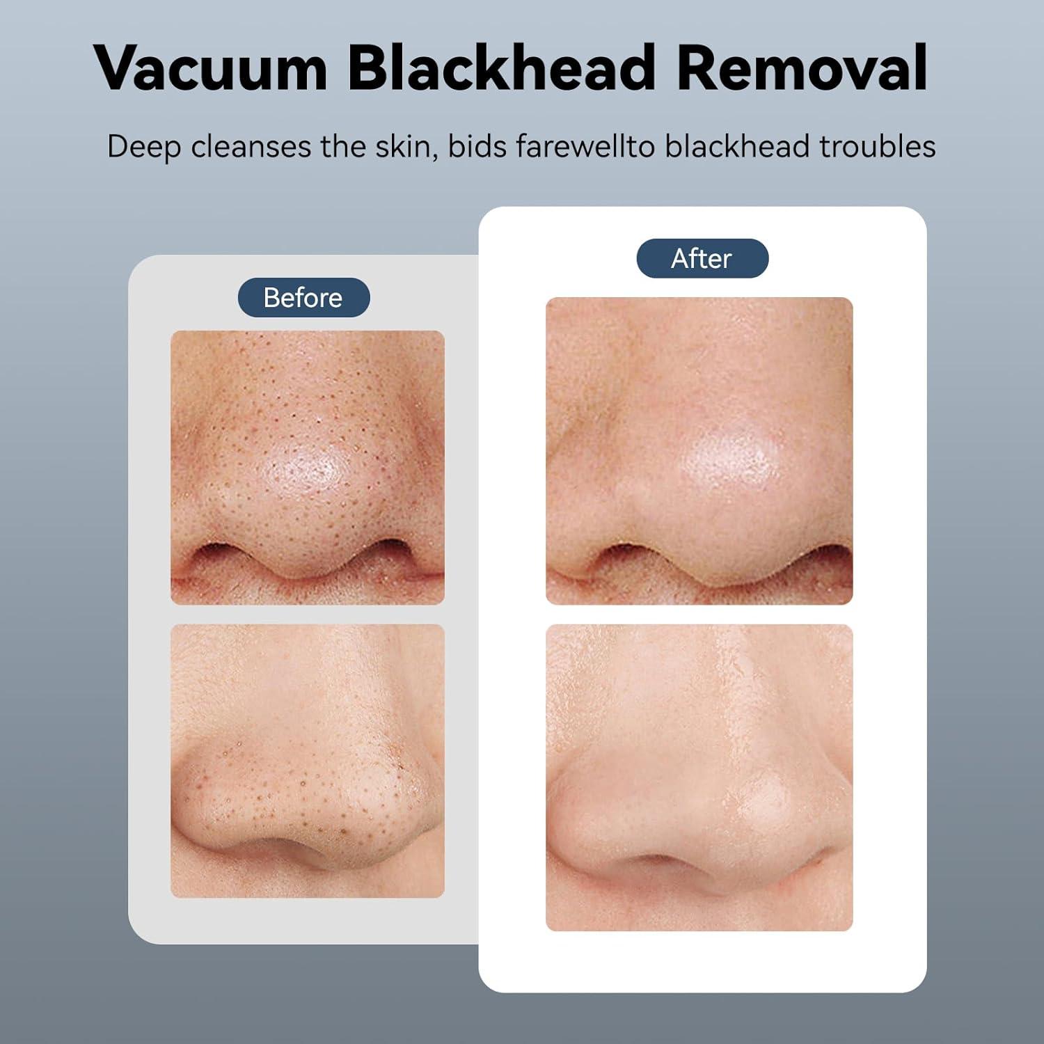 Porenreiniger mit Vakuum, Hot & Cool Funktion